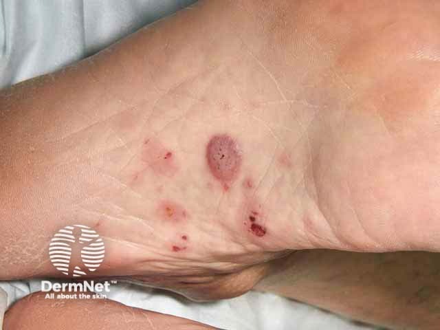 Blisters of bullous pemphigoid on sole of foot, skin of colour