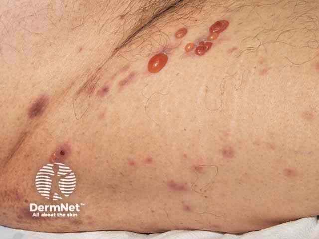 Tense and resolving blisters of bullous pemphigoid on thigh, skin of colour