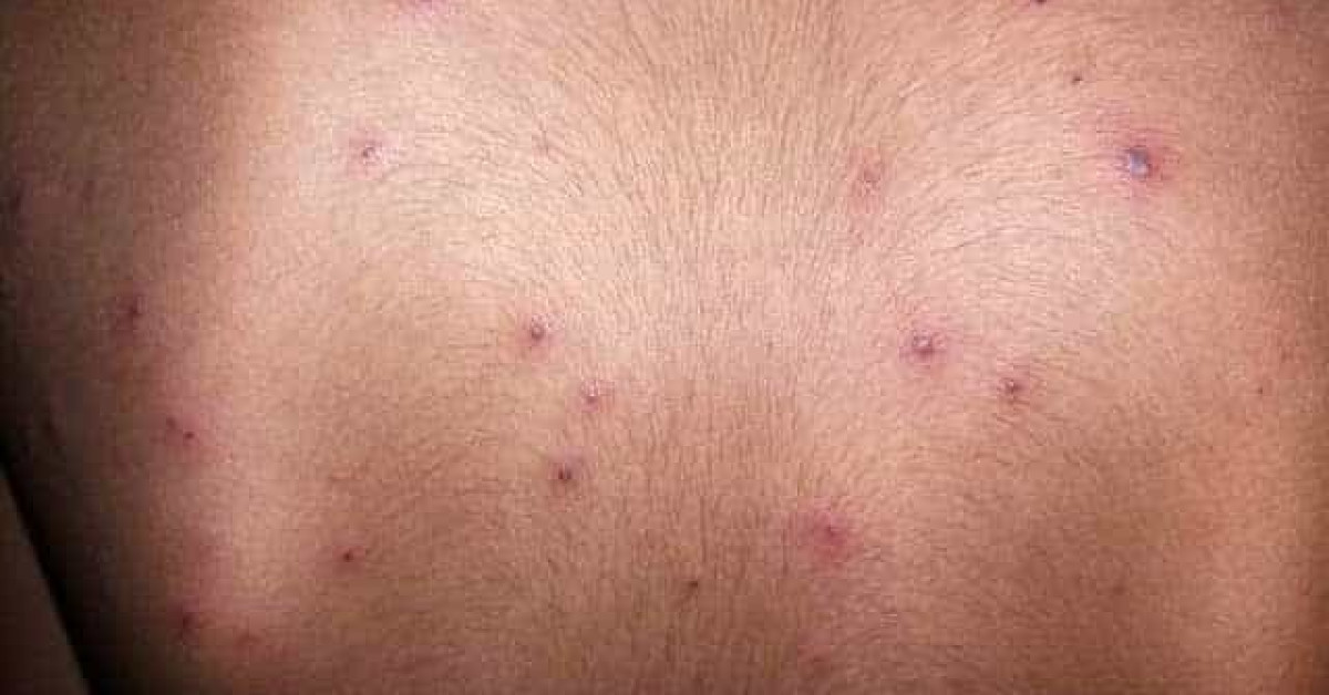 Chickenpox image