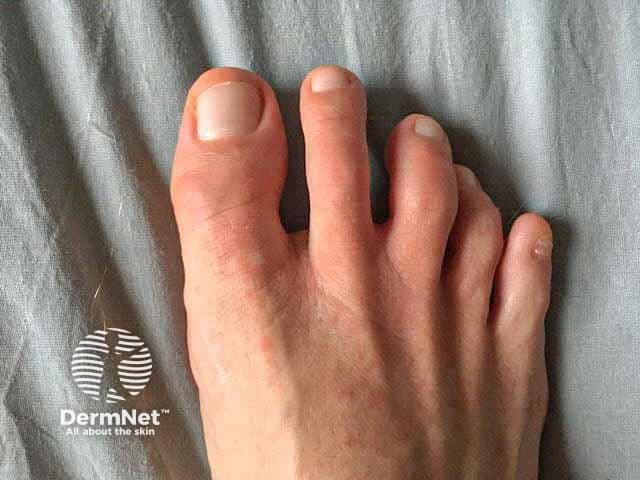 Chilblain-like COVID toes
