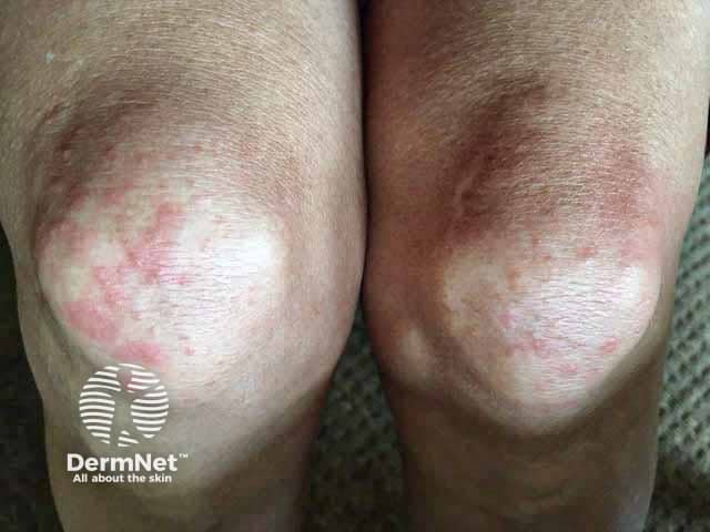 Vesicular lesions on the knees