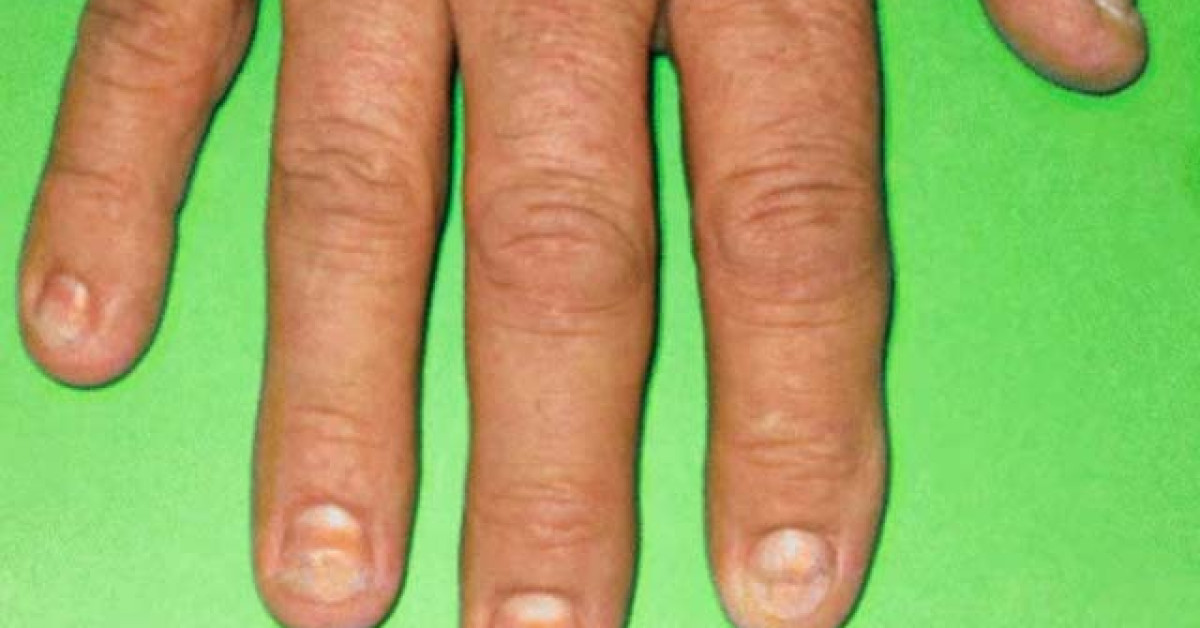 CronkhiteCanada syndrome image