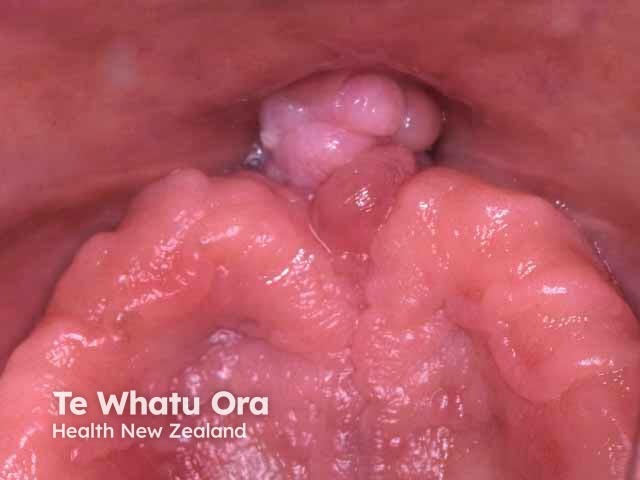 Oral irritated fibroma, maxillary labial frenulum
