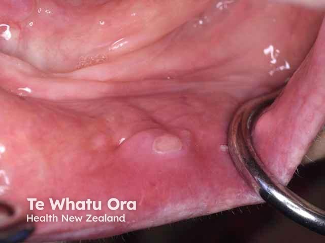 Traumatic mouth ulcer