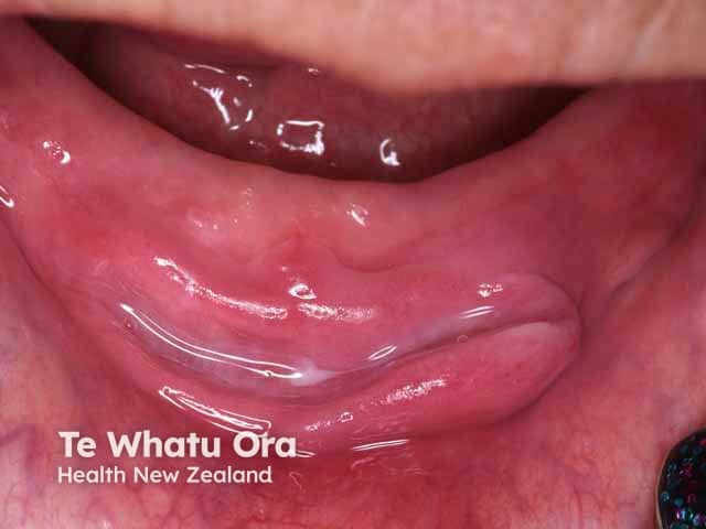 Ulcerated epulis fissuratum, anterior mandibular sulcus