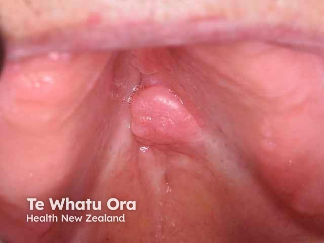 Oral irritated fibroma, hard palate