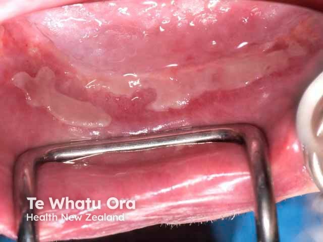 Ulcers in the anterior labial sulcus