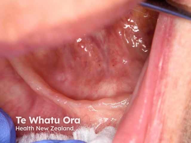Erosions on floor of mouth