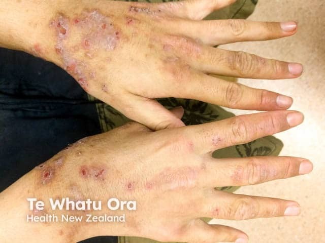 Discoid pattern of eczema on the dorsal hands