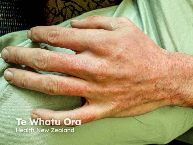 Hand eczema on the back of the hand - mixture of irritant factors in this atopic person