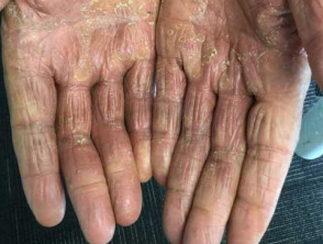 hand dermatitis 00020