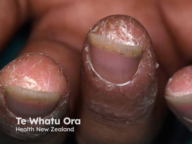 Hand dermatitis on distal fingers