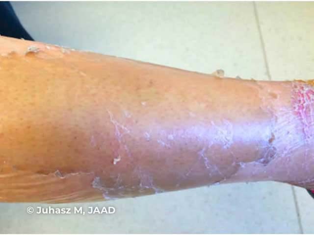 Kwashiorkor: peeling paint dermatosis