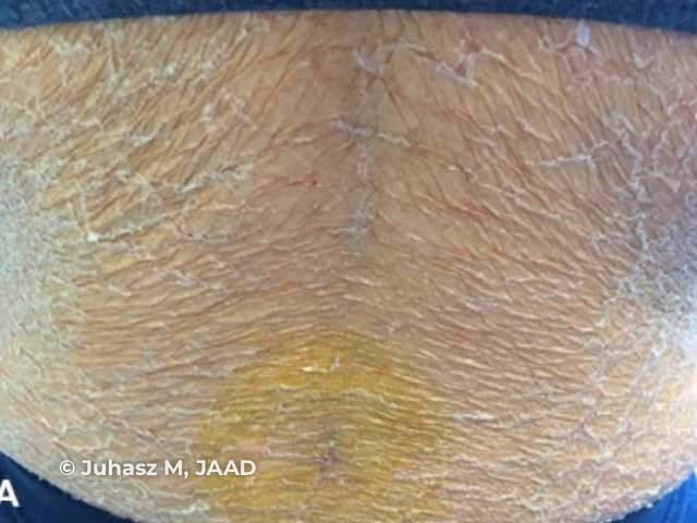 Kwashiorkor: peeling paint dermatosis