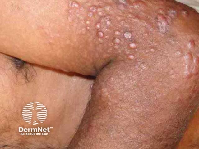Dome-shaped papules and nodules in skin of colour