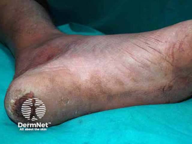 Trophic ulcer on the heel