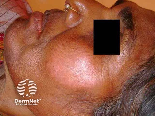 Well-defined erythematous plaque on the cheek in skin of colour