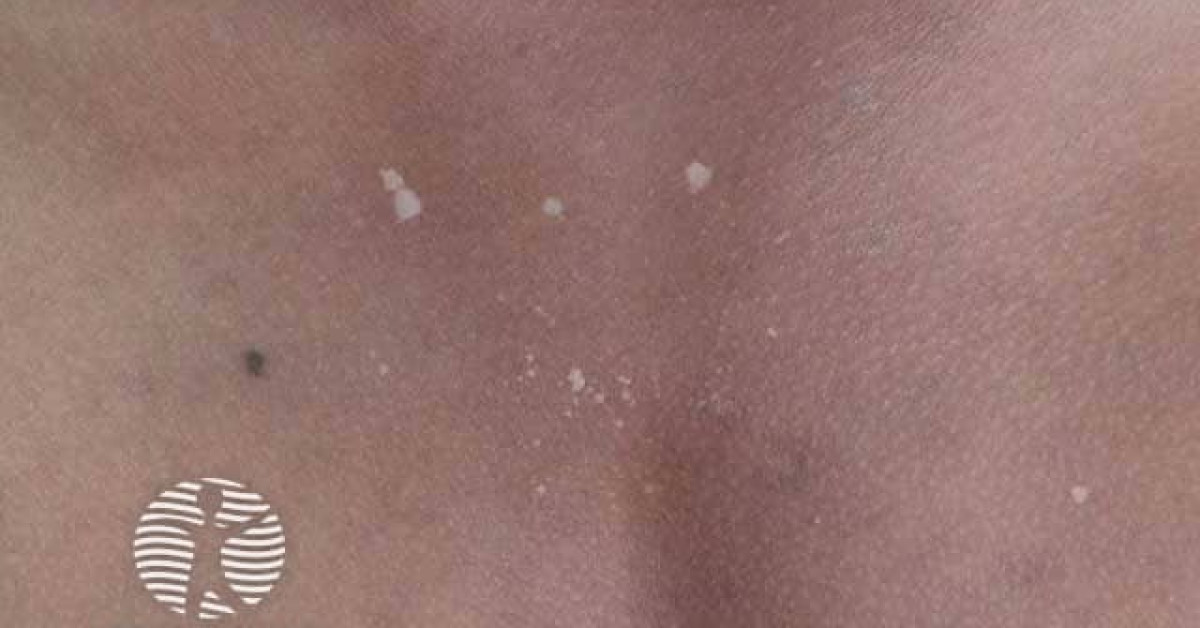 Lichen Sclerosus Specialists Near Me for Effective Treatment