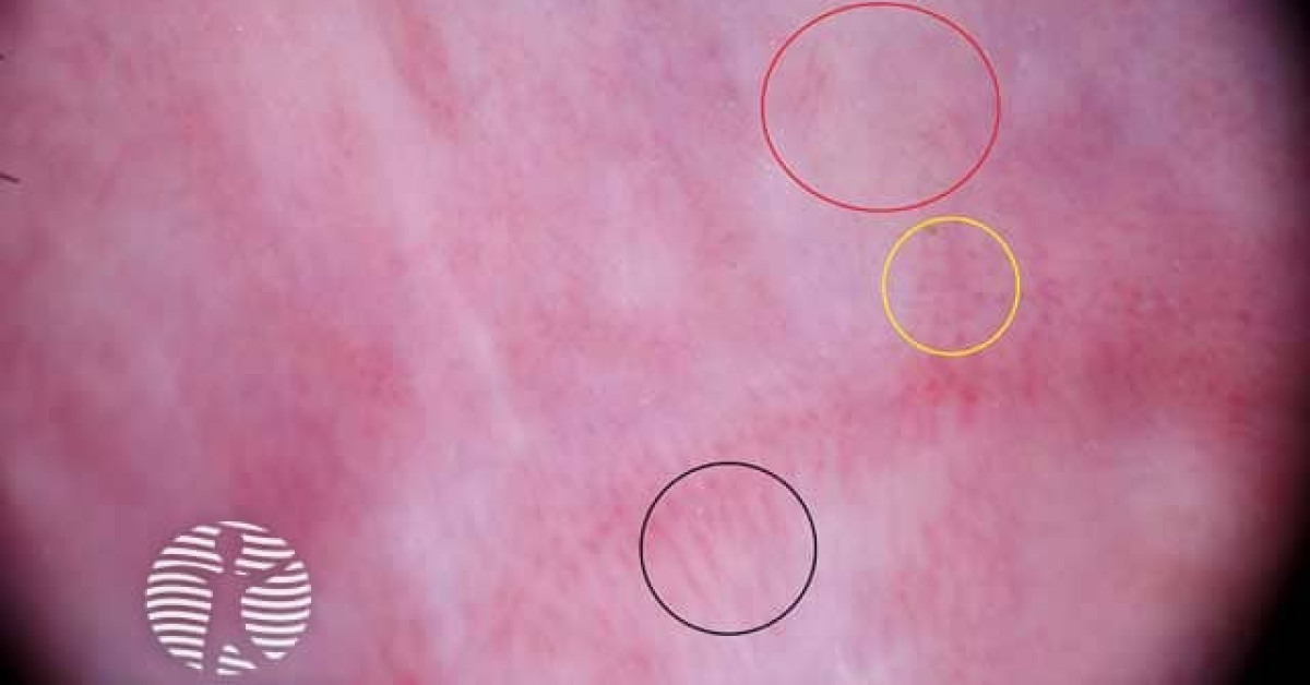 Lichen Sclerosus 00003 Image lichen-sclerosus-00003-image