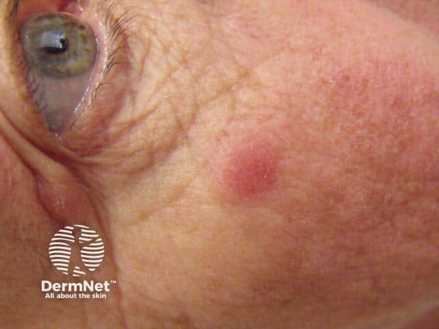 Lupus tumidus, smooth red nodule on the cheek