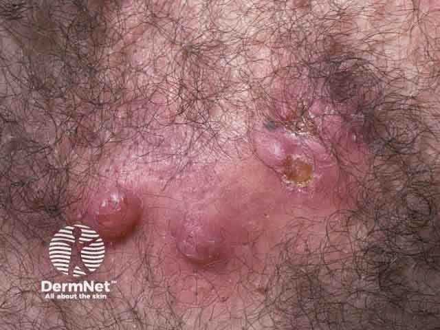 Nodulocystic acne: chest