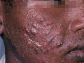 nodulocystic acne 00008