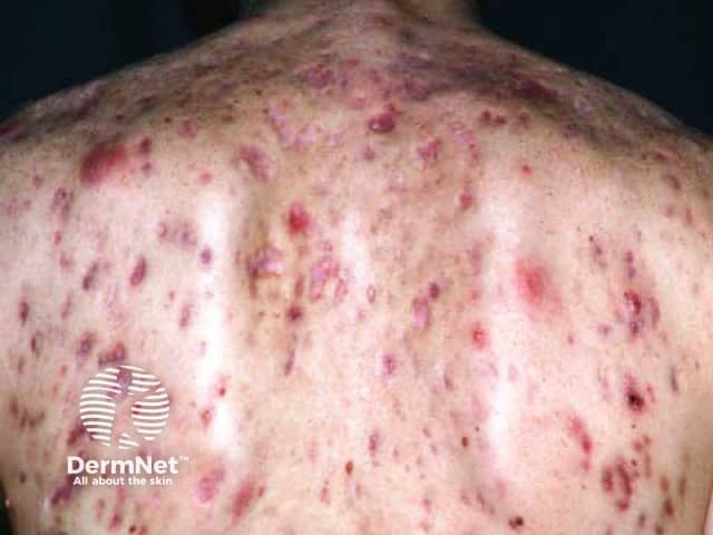 Severe atrophic scarring from back nodulocystic acne
