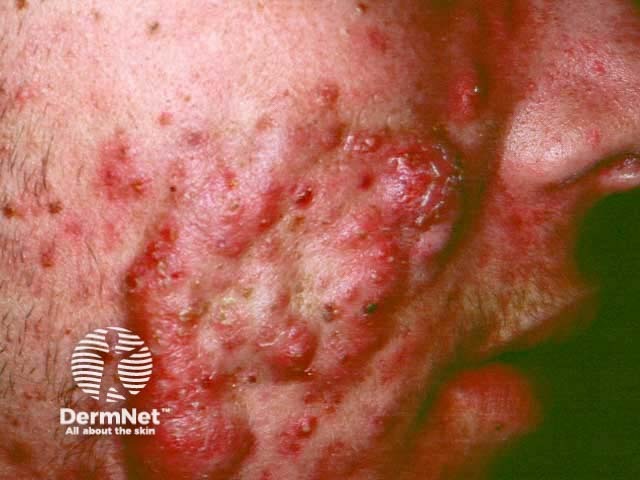 Nodulocystic acne: cheek