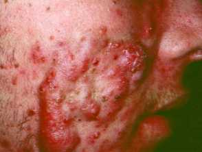 nodulocystic acne 00019