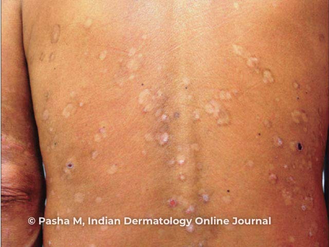 'Leopard skin' sign of cutaneous onchocerciasis