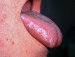 hiv symptoms on lips