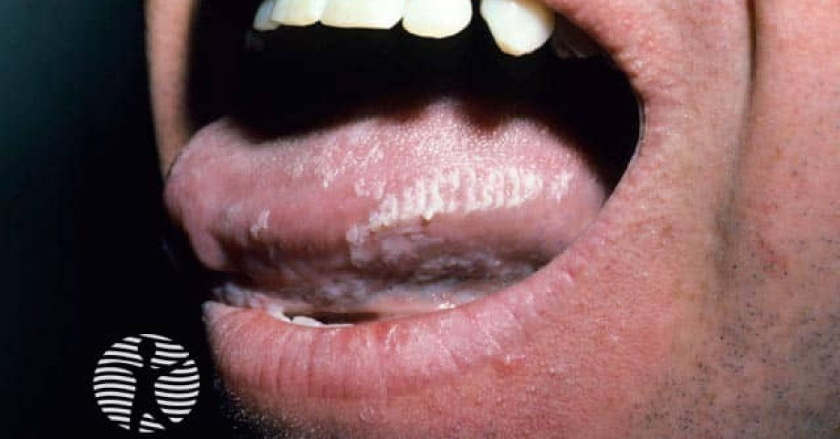 Oral Hairy Leukoplakia 00004 Image 1689