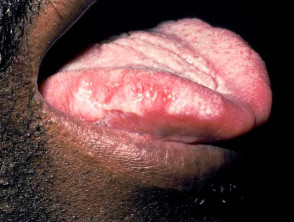 oral hairy leukoplakia 00008