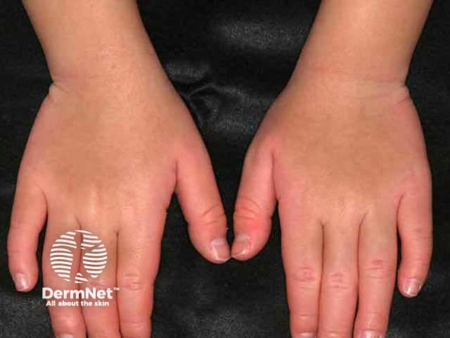 Extension of changes onto the backs of hands (transgradient pattern)