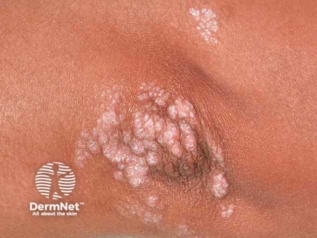 Small plaque psoriasis with prominent scale in skin of colour