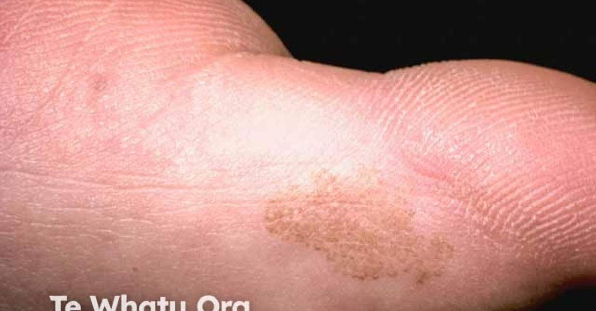 Dermnet® Tinea Nigra Image