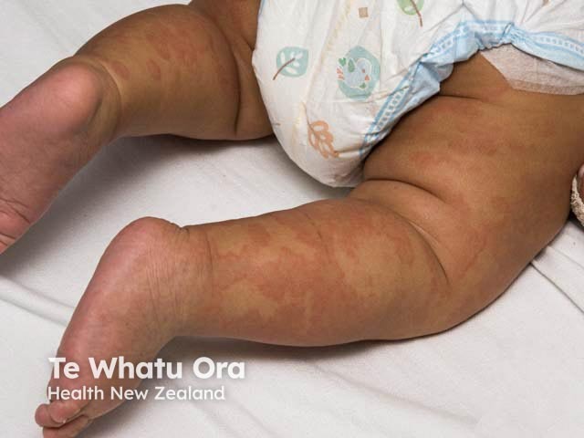 Acute urticarial rash in skin of colour