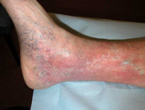 Venous Insufficiency Can Be Debilitating and Deadly If Untreated