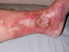 causes of venous stasis dermatitis