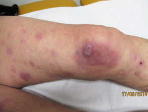 primary cutaneous anaplastic large cell lymphoma 00008