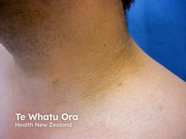 Acanthosis nigricans on the neck