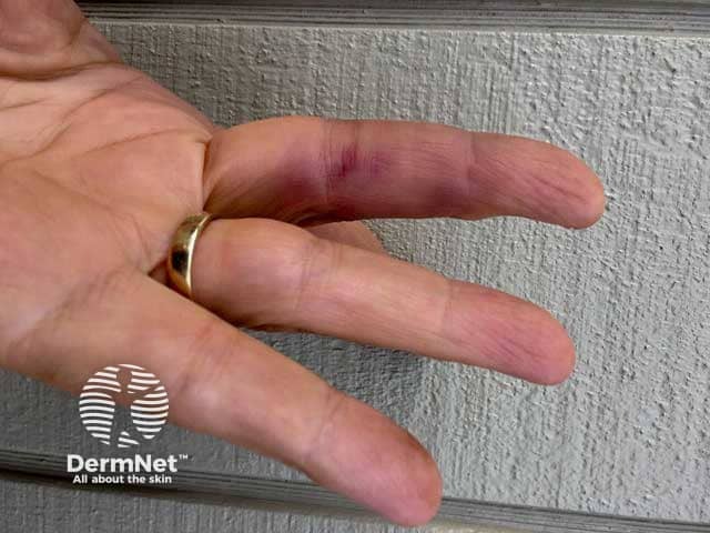 Achenbach syndrome: finger