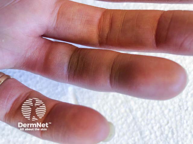 Painful fourth finger bruising after minor trauma from using a broom