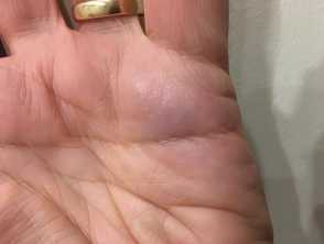 Paroxysmal finger hematoma  Cleveland Clinic Journal of Medicine
