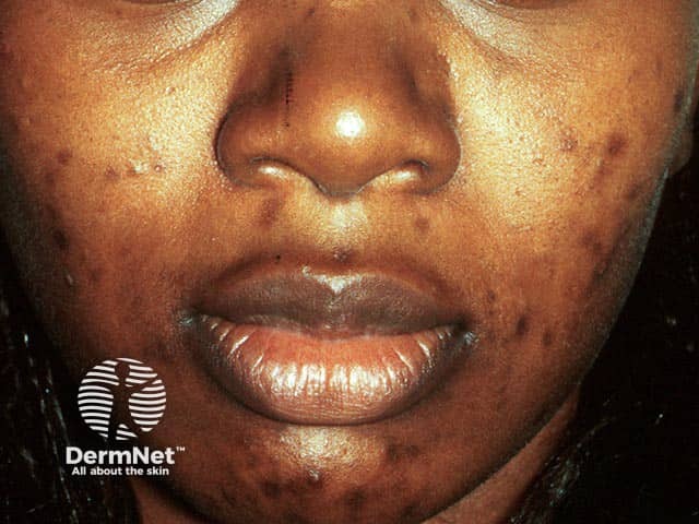 Postinflammatory pigmentation in resolving acne in skin of colour
