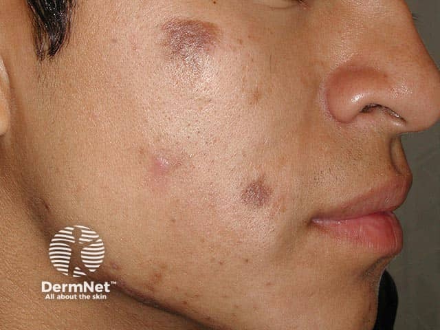Postinflammatory pigmentation from self-therapy with a cryogen for acne scars