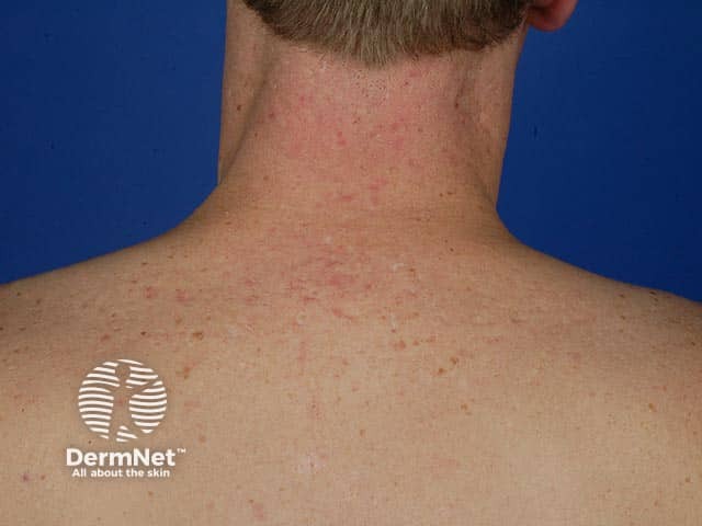 Acne scars around the hairline and upper back
