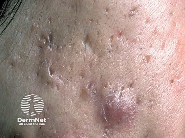 Ice-pick scars and post acne cysts