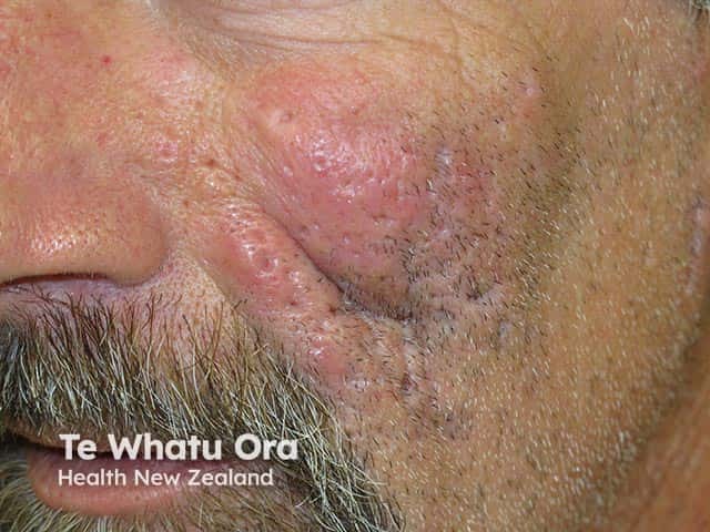 Active nodulocystic acne with atrophic old scars
