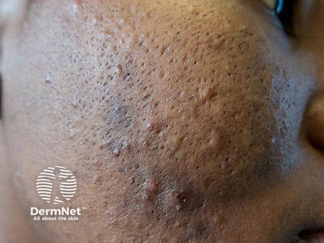 Acne Scarring Images DermNet
